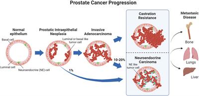 SWI/SNF chromatin remodelers in prostate cancer progression